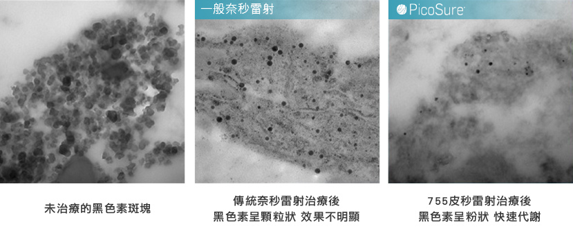 PicoSure755皮秒雷射蜂巢式聚焦陣列透鏡皮秒雷射術後保養凹疤痘疤黑斑凹洞高雄推薦彤耀時尚診所沈育如醫師02.jpg