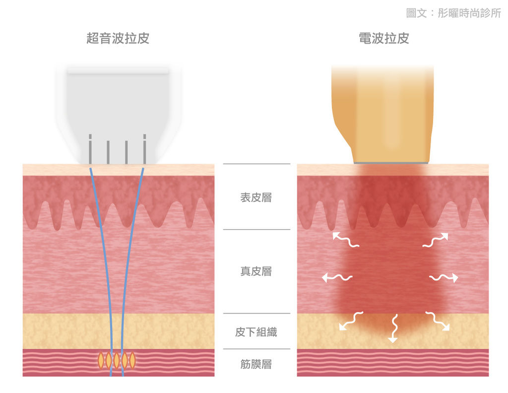 波拉皮電波拉皮副作用音波電波ptt電波拉皮效果彤曜時尚診所門診時間彤曜診所沈育如網美沈育如.jpg