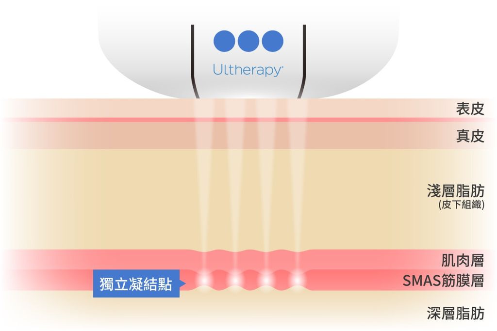 電波拉皮音波拉皮電波拉皮副作用音波電波ptt電波拉皮效果彤曜時尚診所門診時間彤曜診所沈育如網美沈育如.jpg