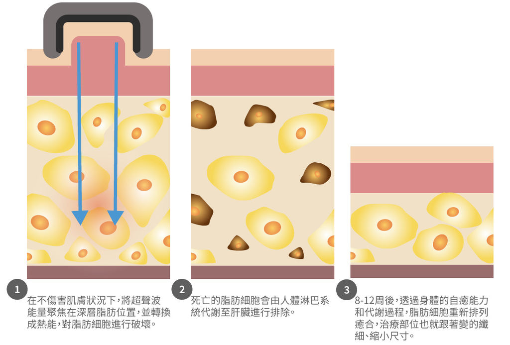 非侵入式體雕立塑價格立塑溶脂ptt立塑手臂立塑聚焦音波溶脂立塑推薦liposonix立塑無創溶脂 (4).jpg