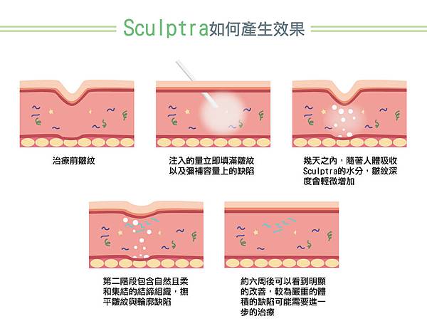 Sculptra.jpg