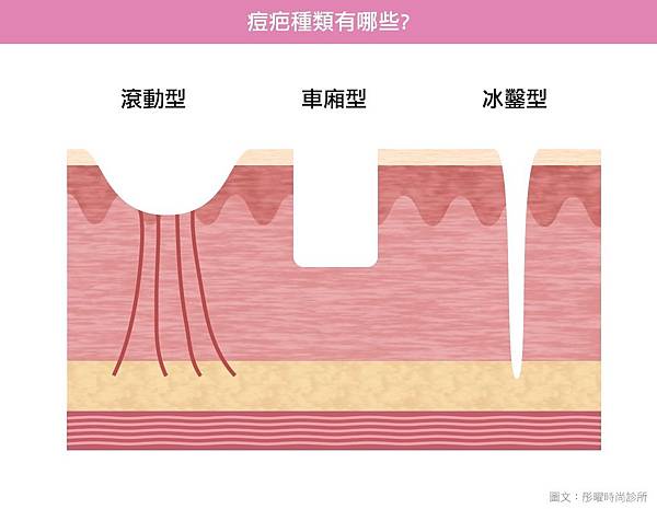 acupulse超脈衝雷射痘疤雷射痘疤治療除凹疤彤曜診所沈育如醫師皮膚專科高雄醫美推薦02.jpg