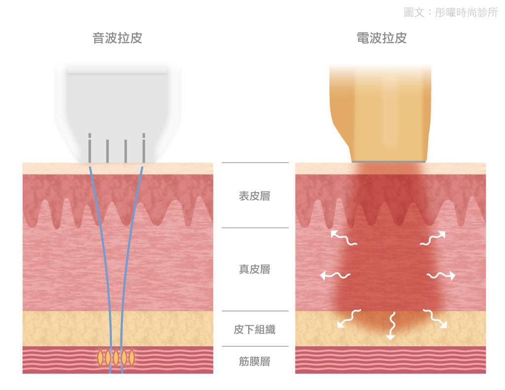 電波拉提.jpg