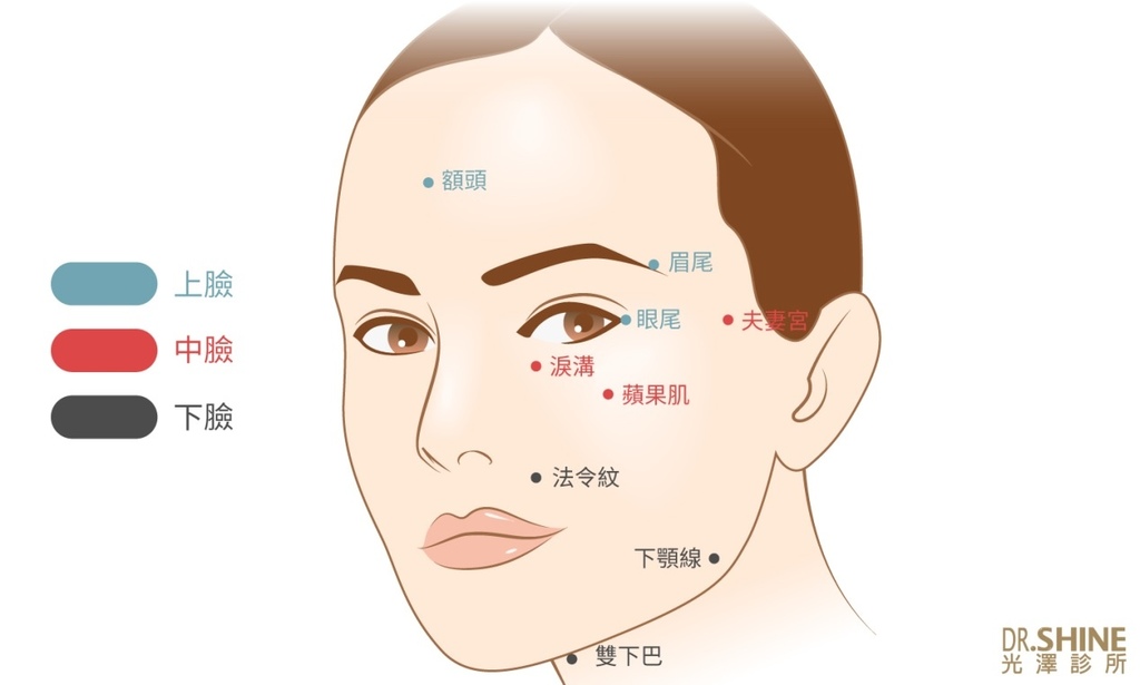 光澤診所藝術面雕微整型Ellanse洢蓮絲3D聚左旋乳酸 (3).jpg 光澤診所藝術面雕微整型Ellanse洢蓮絲3D聚左旋乳酸 (3).jpg