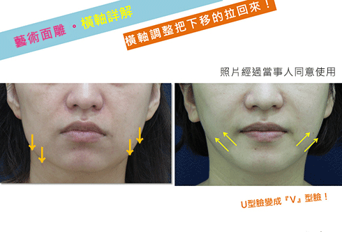 光澤診所藝術面雕微整型Ellanse洢蓮絲3D聚左旋乳酸.gif 光澤診所藝術面雕微整型Ellanse洢蓮絲3D聚左旋乳酸.gif