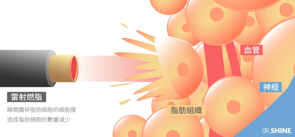 超音波抽脂水刀抽脂腹肌AB線雷射溶脂複合式抽脂5 超音波抽脂水刀抽脂腹肌AB線雷射溶脂複合式抽脂5