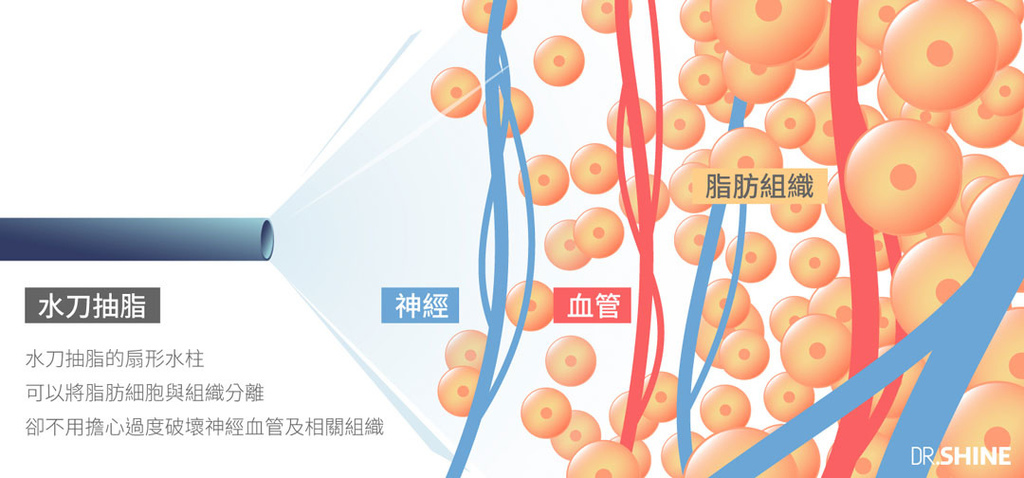 超音波抽脂水刀抽脂腹肌AB線雷射溶脂複合式抽脂4