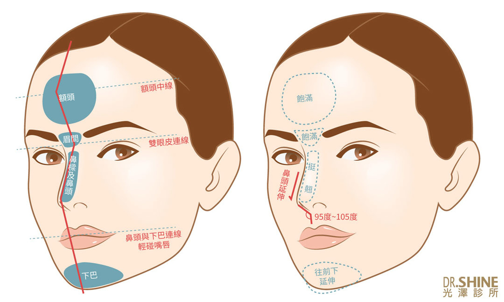 板橋光澤診所藝術面雕微整型Ellanse洢蓮絲3D聚左旋乳酸抗老五官雕塑 (3).jpg 板橋光澤診所藝術面雕微整型Ellanse洢蓮絲3D聚左旋乳酸抗老五官雕塑 (3).jpg