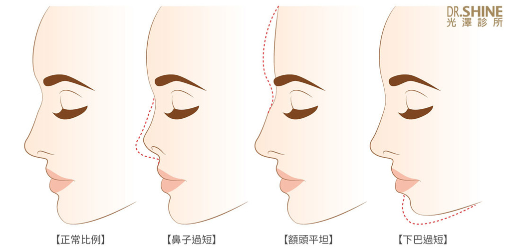板橋光澤診所藝術面雕微整型Ellanse洢蓮絲3D聚左旋乳酸抗老五官雕塑 (4).jpg 板橋光澤診所藝術面雕微整型Ellanse洢蓮絲3D聚左旋乳酸抗老五官雕塑 (4).jpg