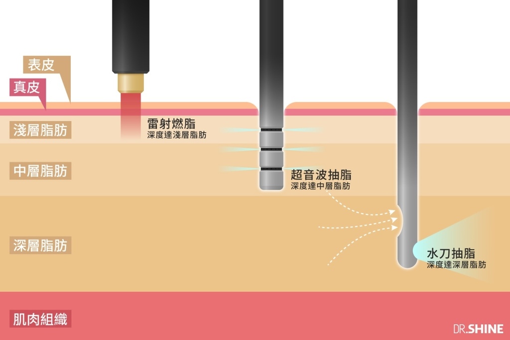 抽脂手術抽脂手術費用抽脂手術風險抽脂副作用全身抽脂價格腹部抽脂費用水刀抽脂價格抽脂手術後複合式抽脂水刀抽脂雷射溶脂超音波抽脂光澤診所光澤抽脂手臂抽脂QA問題術後恢復 抽脂手術抽脂手術費用抽脂手術風險抽脂副作用全身抽脂價格腹部抽脂費用水刀抽脂價格抽脂手術後複合式抽脂水刀抽脂雷射溶脂超音波抽脂光澤診所光澤抽脂手臂抽脂QA問題術後恢復
