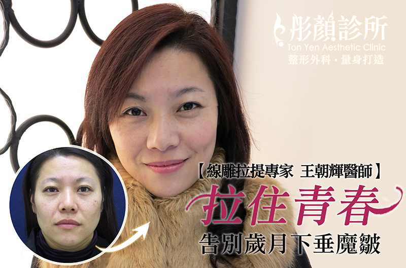 【線雕拉提專家 王朝輝醫師】拉住青春,告別歲月下垂魔皺! -線雕拉提-拉皮-玻尿酸-V型臉 【線雕拉提專家 王朝輝醫師】拉住青春,告別歲月下垂魔皺! -線雕拉提-拉皮-玻尿酸-V型臉