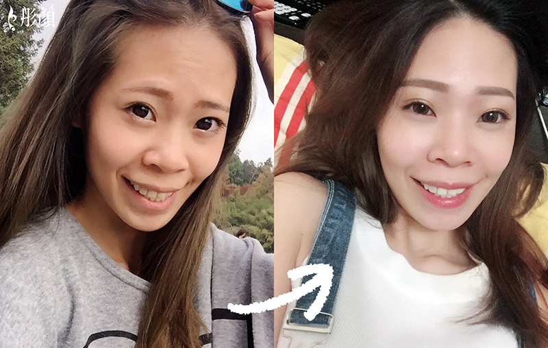 凹陷苦命臉hen顯老?免手術・藝術面雕打造少女般澎潤好面相 -微整形-夫妻宮-淚溝-蘋果肌-法令紋-盧威廷醫師 凹陷苦命臉hen顯老?免手術・藝術面雕打造少女般澎潤好面相 -微整形-夫妻宮-淚溝-蘋果肌-法令紋-盧威廷醫師