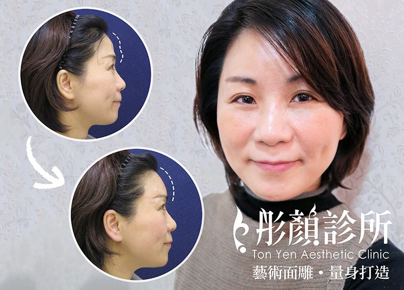 貴婦美顏來自飽滿天庭!玻尿酸豐額,填補夫妻宮 —藝術面雕,微整形,自體補脂,額頭,蘋果肌,夫妻宮,盧威廷醫師,陳錫賢醫師 貴婦美顏來自飽滿天庭!玻尿酸豐額,填補夫妻宮 —藝術面雕,微整形,自體補脂,額頭,蘋果肌,夫妻宮,盧威廷醫師,陳錫賢醫師