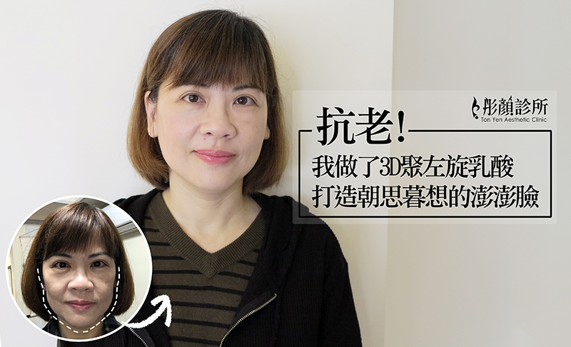 抗老!我做了3D聚左旋乳酸,打造朝思暮想的澎澎臉-盧威廷 醫師-藝術面雕- Sculptra舒顏萃-童顏針 抗老!我做了3D聚左旋乳酸,打造朝思暮想的澎澎臉-盧威廷 醫師-藝術面雕- Sculptra舒顏萃-童顏針