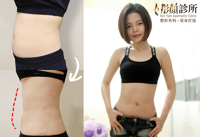 就是要炫「腹」!擺脫小腹婆,我用藝術體雕-脂雕達人 陳錫賢醫師-複合式抽脂-腹部環抽 就是要炫「腹」!擺脫小腹婆,我用藝術體雕-脂雕達人 陳錫賢醫師-複合式抽脂-腹部環抽