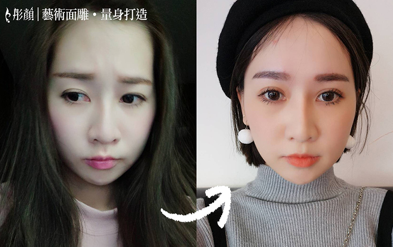 表情人的救星~肉毒桿菌 除「ㄦ」字皺眉紋,皮膚光滑緊實! -魚尾紋,抬頭紋,洪維志醫師,微整形,藝術面雕 表情人的救星~肉毒桿菌 除「ㄦ」字皺眉紋,皮膚光滑緊實! -魚尾紋,抬頭紋,洪維志醫師,微整形,藝術面雕