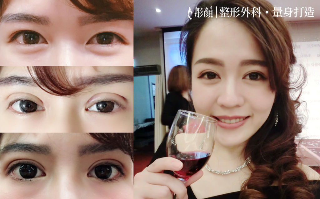 彷彿天生!後悔沒早做「訂書針雙眼皮」打造夢寐以求的明亮電眼~整形外科 劉宏貞醫師,大小眼,眼摺不對稱 彷彿天生!後悔沒早做「訂書針雙眼皮」打造夢寐以求的明亮電眼~整形外科 劉宏貞醫師,大小眼,眼摺不對稱