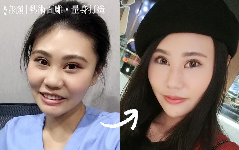 小小微調,打造「挺鼻+尖下巴」立體臉部線條,魅力自然散發-盧威廷醫師,藝術面雕,微整形,玻尿酸,隆鼻,墊下巴 小小微調,打造「挺鼻+尖下巴」立體臉部線條,魅力自然散發-盧威廷醫師,藝術面雕,微整形,玻尿酸,隆鼻,墊下巴