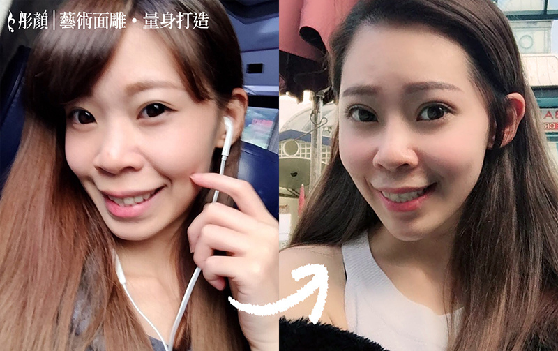 微整形這樣做!精緻.亮顏.人緣激增!-藝術面雕專家 王朝輝醫師-依戀詩-玻尿酸 微整形這樣做!精緻.亮顏.人緣激增!-藝術面雕專家 王朝輝醫師-依戀詩-玻尿酸