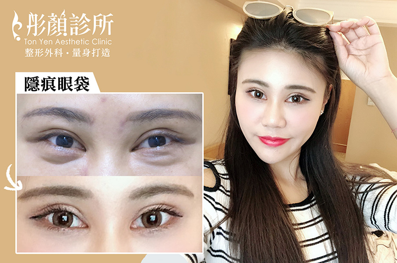 貓熊眼袋有救了!【隱痕眼袋】手術快.輕修護,迅速年輕有神!-眼袋內開,整形外科 劉宏貞醫師 貓熊眼袋有救了!【隱痕眼袋】手術快.輕修護,迅速年輕有神!-眼袋內開,整形外科 劉宏貞醫師