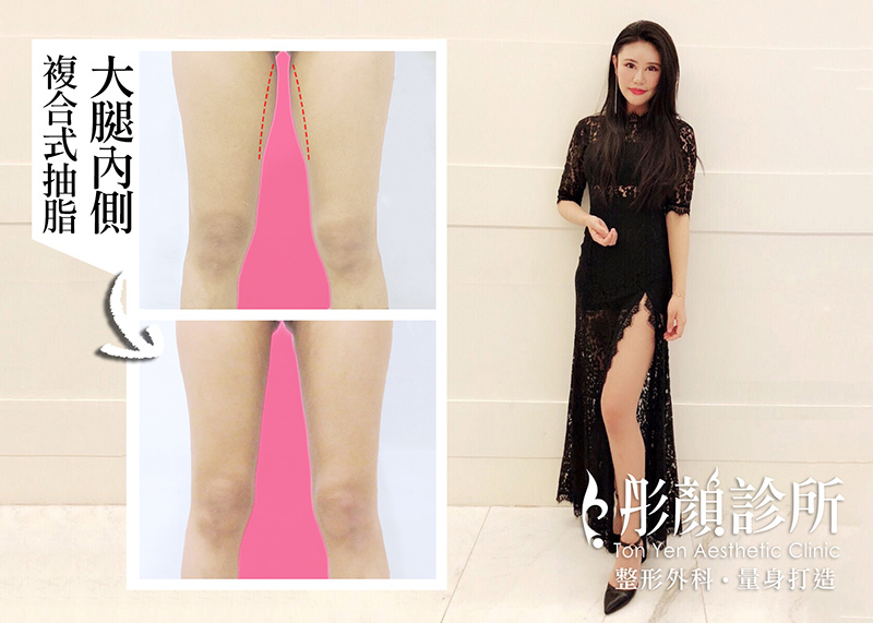 你有「大腿縫」了嗎? 迎接夏天~擁有纖細顯瘦美腿不是夢!-洪維志醫師,大腿抽脂,複合式抽脂,藝術體雕 你有「大腿縫」了嗎? 迎接夏天~擁有纖細顯瘦美腿不是夢!-洪維志醫師,大腿抽脂,複合式抽脂,藝術體雕