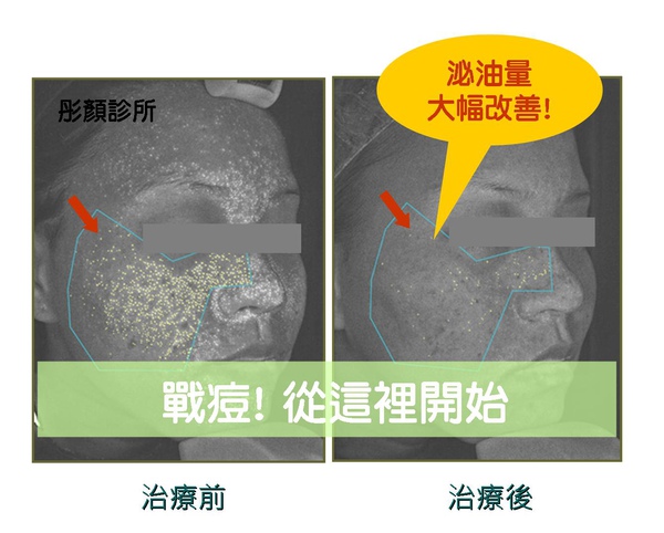 AB酸煥膚.jpg AB酸煥膚.jpg