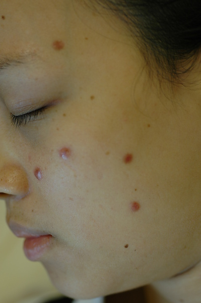 scar after nevus tx