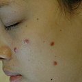 scar after nevus tx