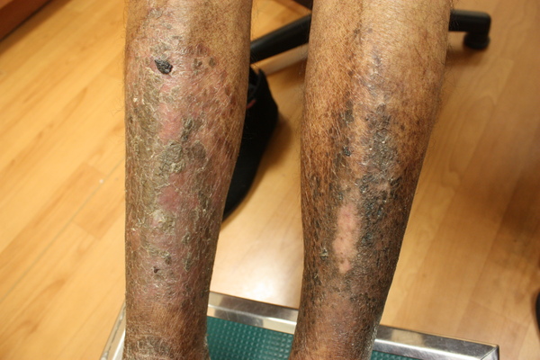chronic asteatotic dermatitis (4).JPG