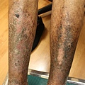 chronic asteatotic dermatitis (4).JPG