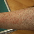 acute asteatotic dermatitis.JPG