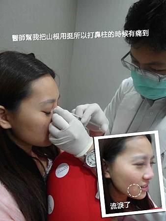 玻尿酸隆鼻07 玻尿酸隆鼻07