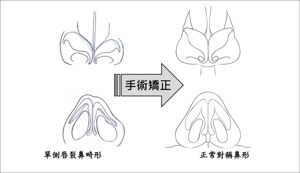 唇裂鼻畸形_矯正成_對稱鼻形 v2016-04-09