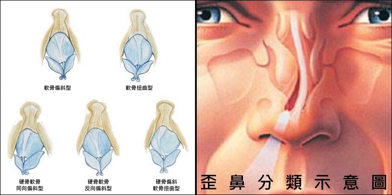 醫師專欄 鼻整形 歪鼻矯正手術 可合併解決鼻塞與美觀問題correction Of Twisted Crooked Deviated Nose Dr Wu Rhinoplasty 吳志賢醫師 鼻整形重建中心 痞客邦 醫師專欄 鼻整形 歪鼻矯正手術 可合併解決鼻塞與美觀問題correction Of Twisted Crooked Deviated Nose Dr Wu Rhinoplasty 吳志賢醫師 鼻整形重建中心 痞客邦