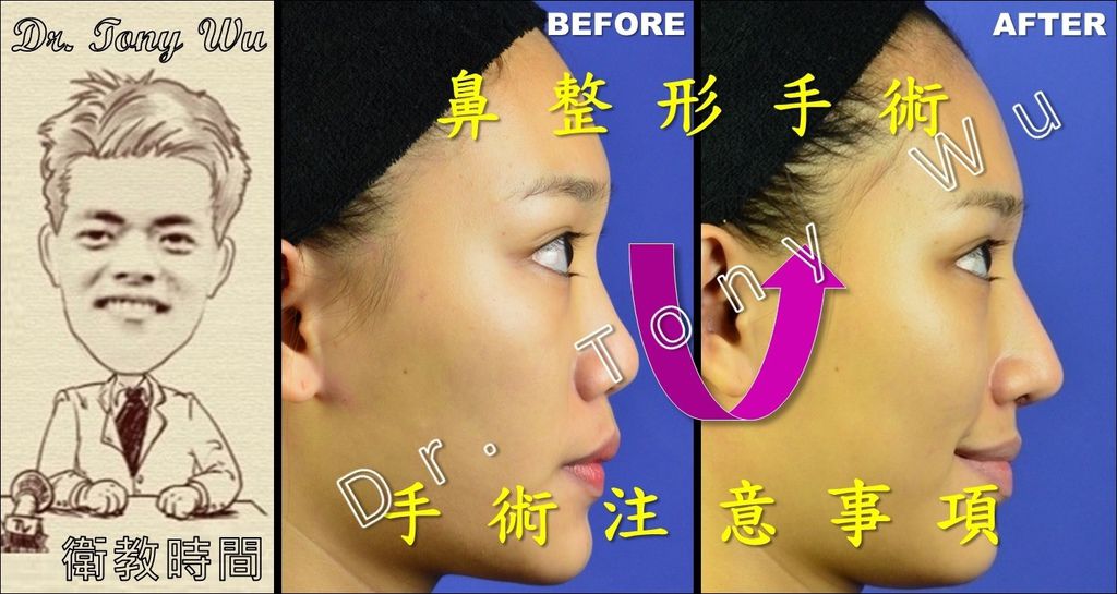 衛教 鼻整形 隆鼻 手術 注意事項 懶人包大解密instruction For Rhinoplasty Complete Collection Dr Wu Rhinoplasty 吳志賢醫師 鼻整形重建中心 痞客邦