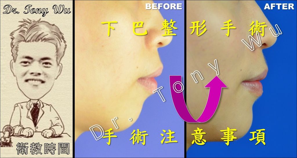[手術衛教] 下巴整形手術-注意事項 v2016-07-08