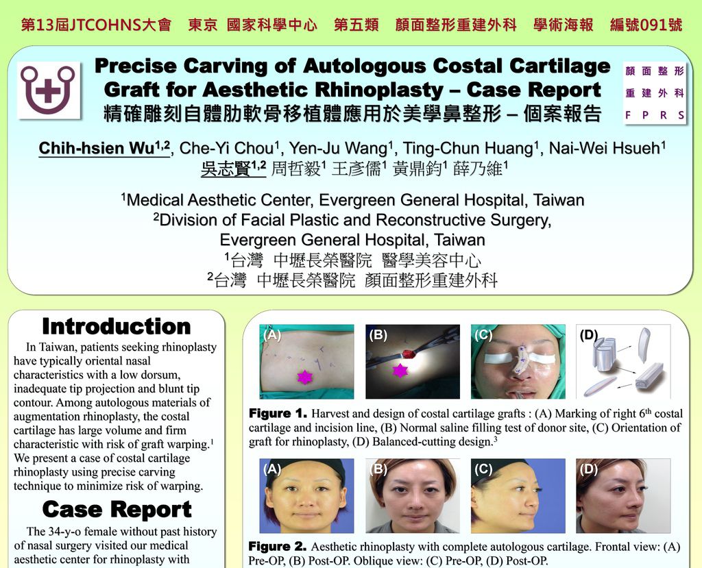 2015.12.03~04 精確雕刻自體肋軟骨移植體應用於美學鼻整形-個案報告