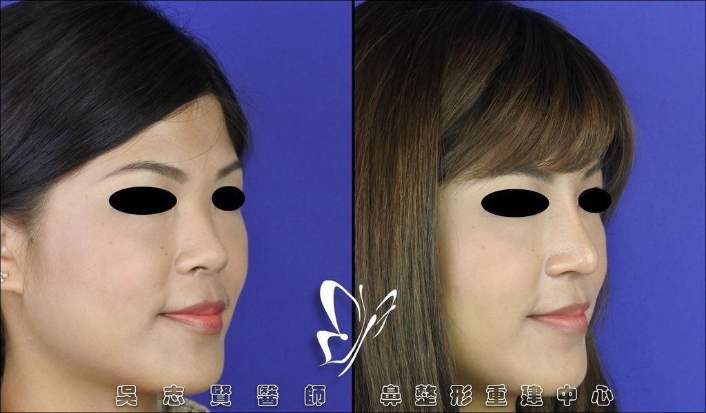 衛教 鼻整形 隆鼻 術前術後照護須知 按日期 懶人包大解密care For Rhinoplasty Complete Collection Dr Wu Rhinoplasty 吳志賢醫師 鼻整形重建中心 痞客邦