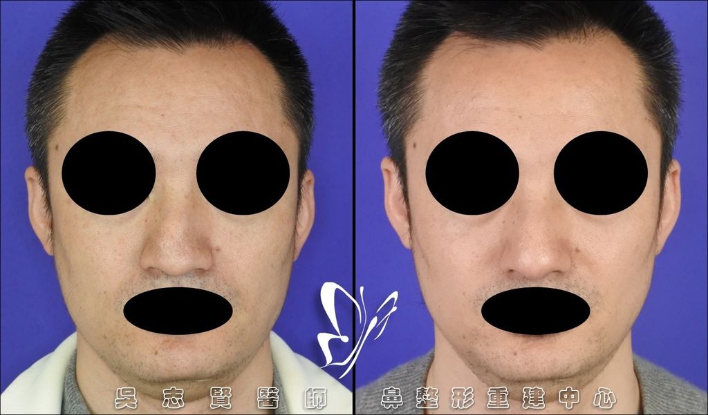 衛教 鼻整形 隆鼻 術前術後照護須知 按日期 懶人包大解密care For Rhinoplasty Complete Collection Dr Wu Rhinoplasty 吳志賢醫師 鼻整形重建中心 痞客邦