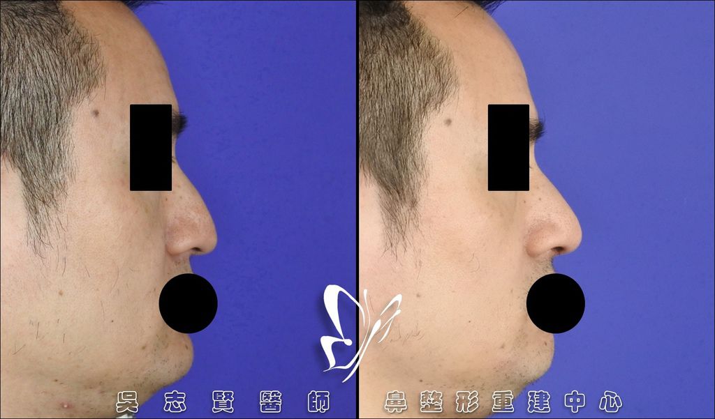 【案例】 自體肋軟骨歪鼻矯正手術 2016-12 (5)