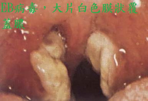 你的小孩喉嚨 捕狼 化膿 了嗎 化膿性扁桃腺炎 趕緊來看看怎麼處理 王杰凱小兒科的醫療服事園地 痞客邦
