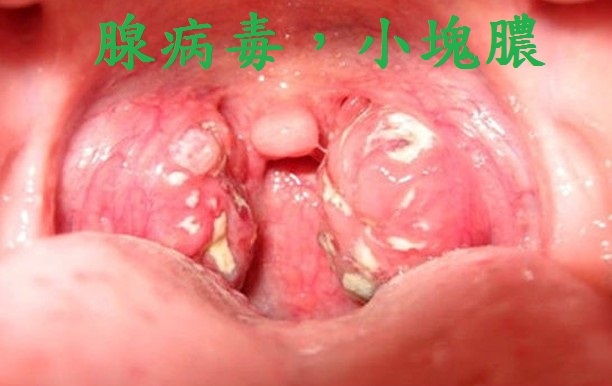 adenovirus tonsillitis.jpg