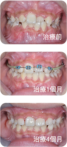 早期矯正治療 楊登凱齒顎矯正專科醫師 痞客邦 早期矯正治療 楊登凱齒顎矯正專科醫師 痞客邦