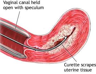 dilationandcurettage_3 dilationandcurettage_3