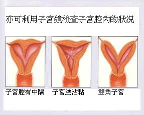 uterus uterus