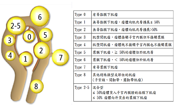 因應不同位置，切除肌瘤或消融肌瘤之選擇