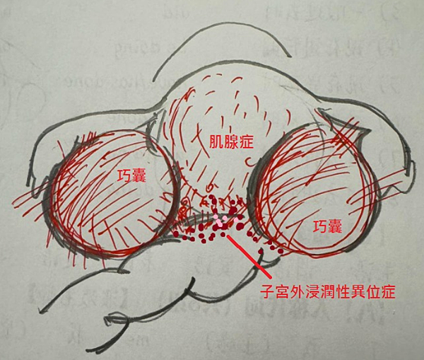 藥物控制到切除之間的新選擇: 熱消融肌瘤、肌腺症