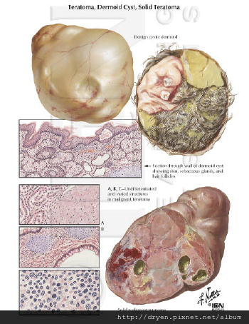 dermoid.jpg