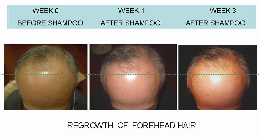 NO-2 week 0 VS 3 FORHEAD