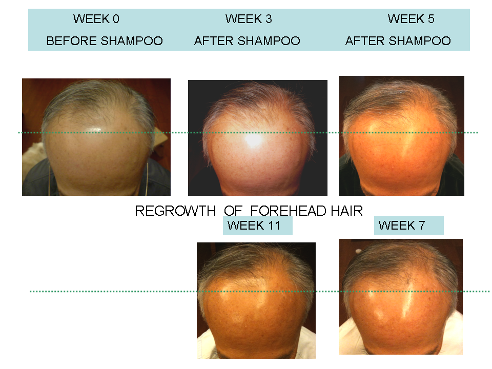 NO-2 week 0 VS 11 FORHEAD